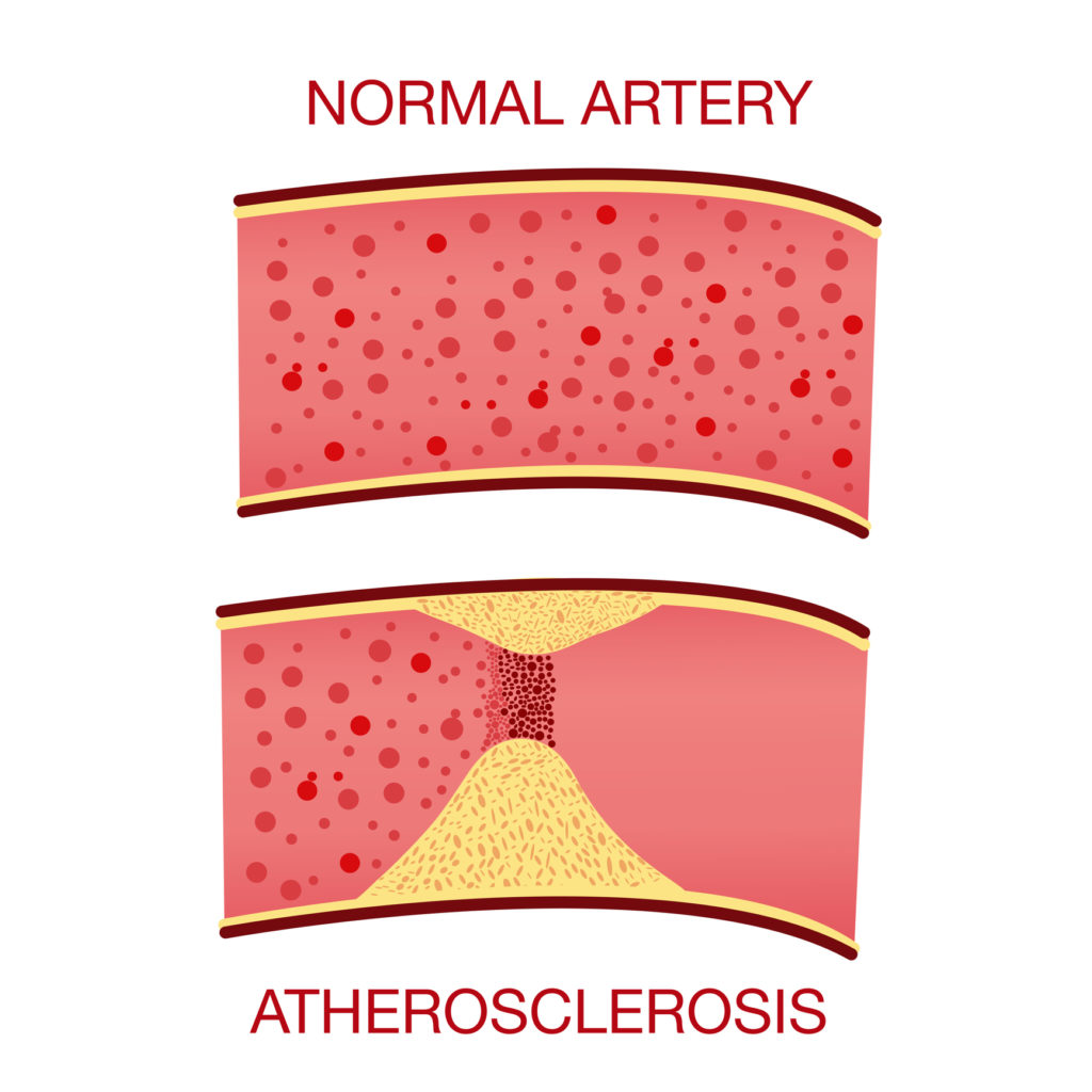 Illustration of atherosclerosis of the arteries