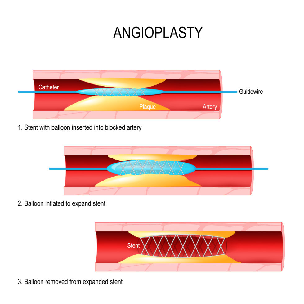 Percutaneous coronary intervention (or stent) Patient procedure guide