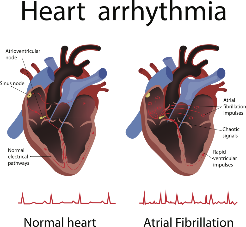 diagram of heart arrhythmia