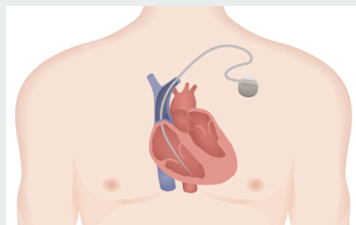 permanent pacemaker placement