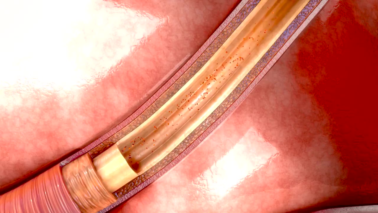 Heart attacks cause one in 20 deaths